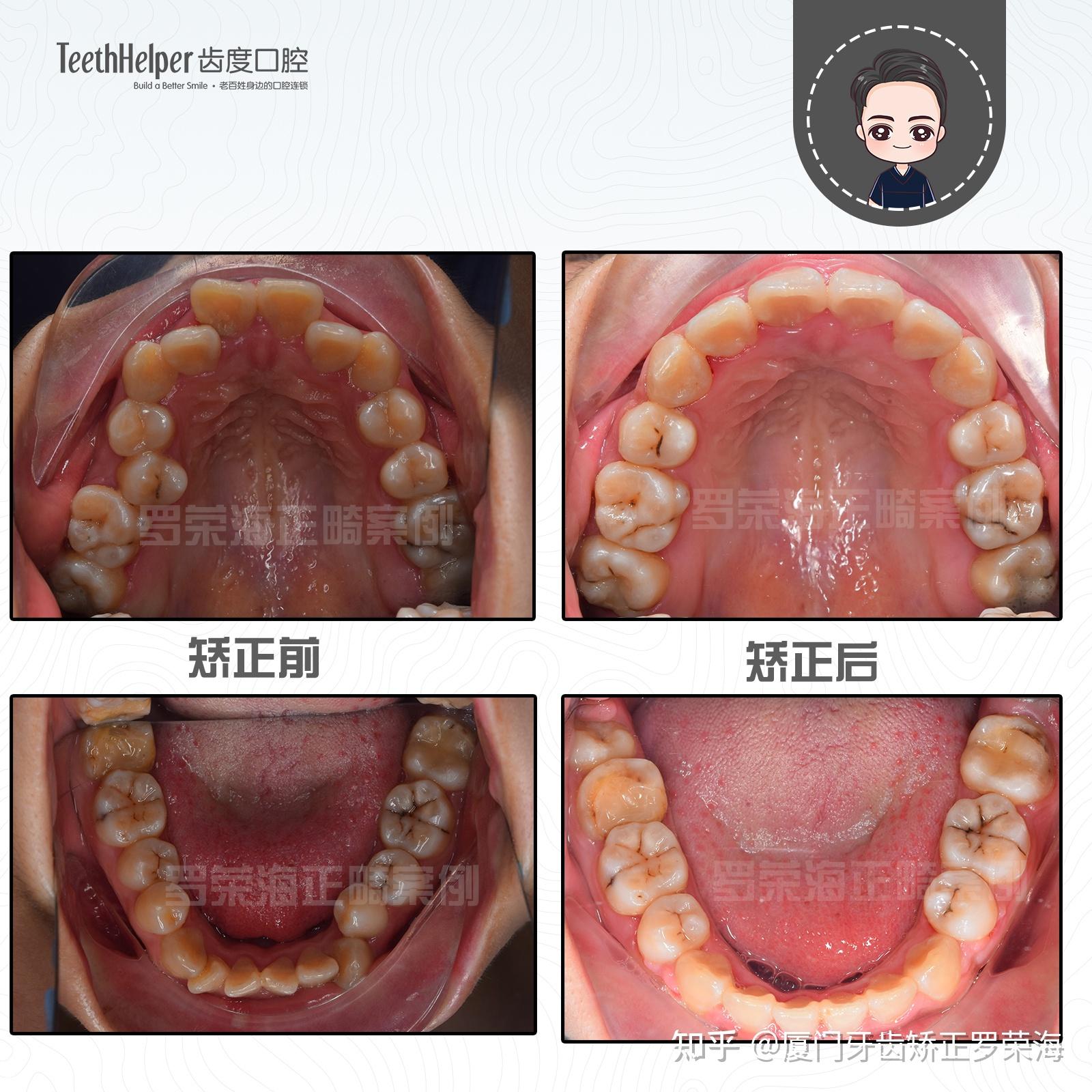 廈門牙齒矯正案例牙齒不齊前突金屬牙套矯正一年半