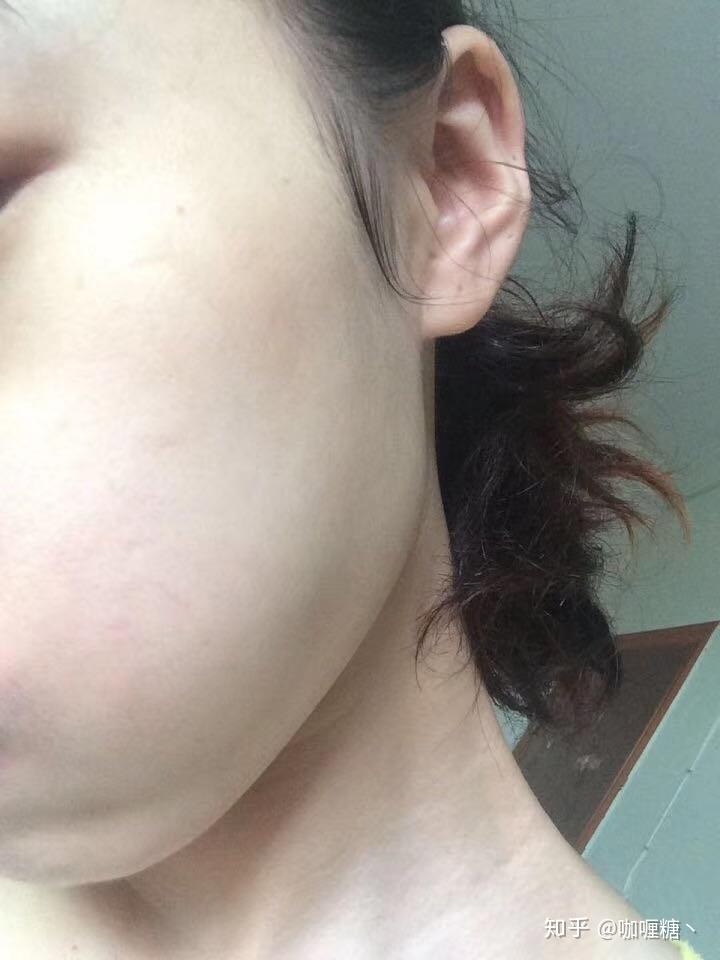 额头痘痘是怎么引起的 v2-5affa821f49866db676faea1df354b28_r.jpg