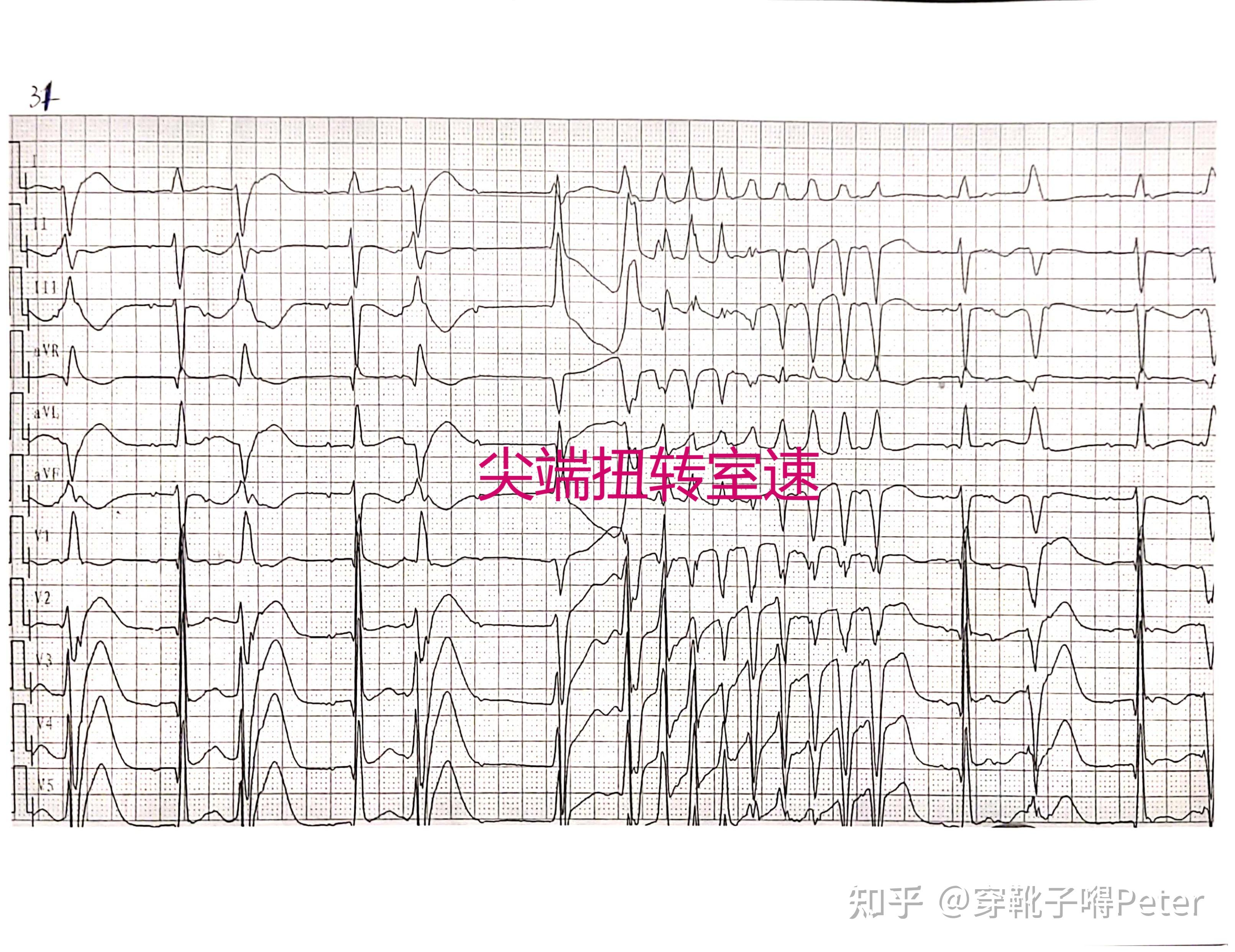 室速的心电图表现图片