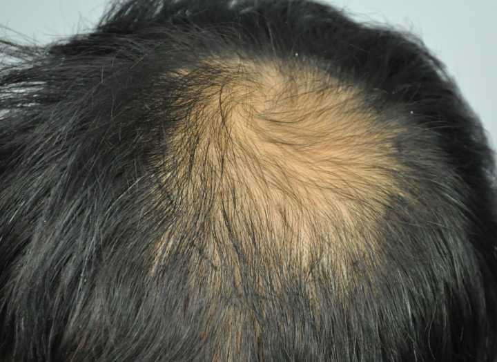 一般说来,基因引起的雄激素脱发只会顶部头发稀疏和发际线后移外,后脑