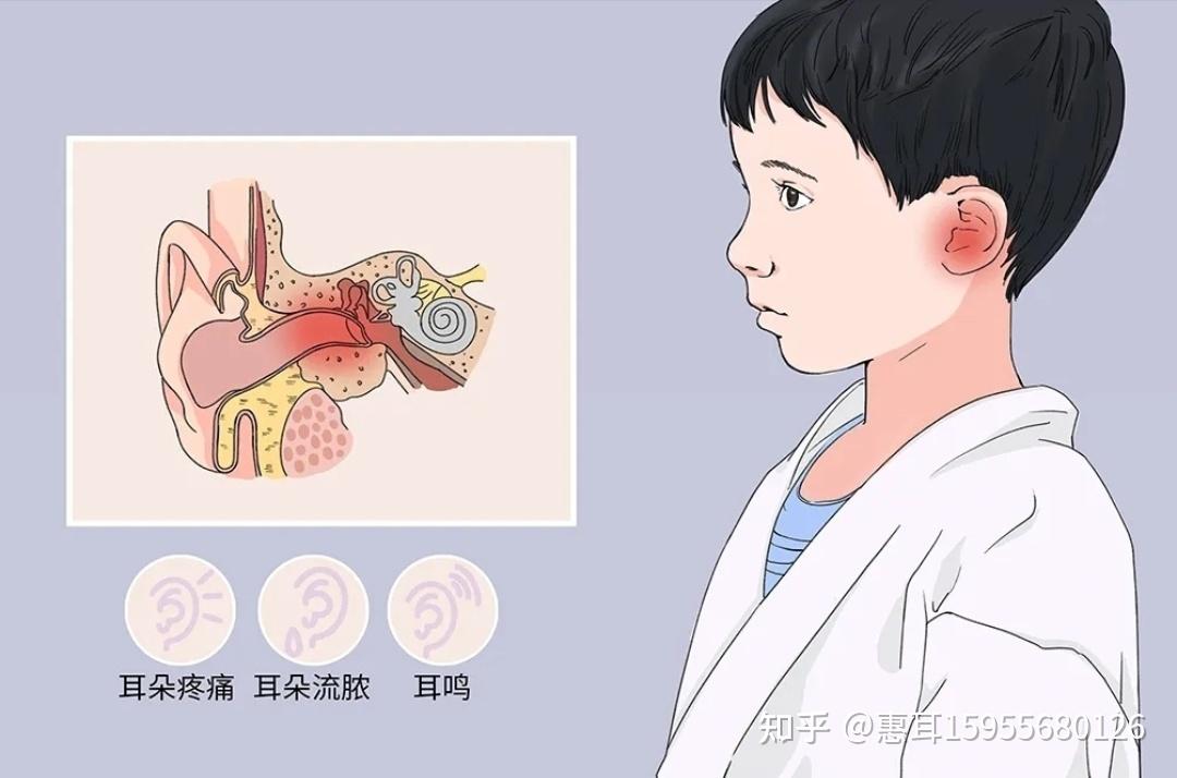 中耳炎會引起聽力下降嗎 - 知乎