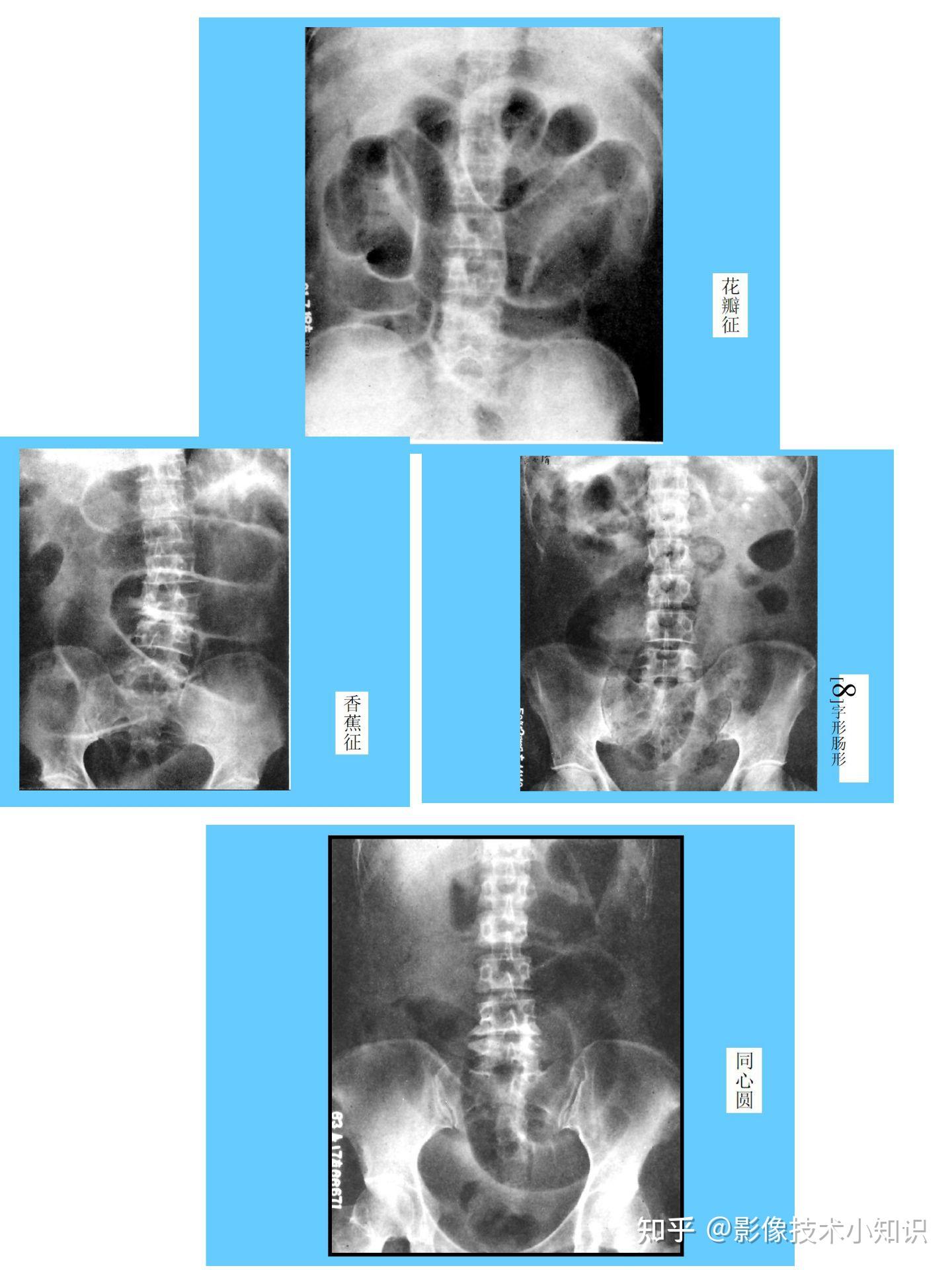 肠梗阻的x线图片