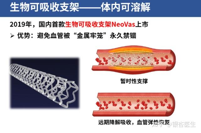 创新产品造福冠心病患者 生物可吸收支架受多方关注 - 知乎