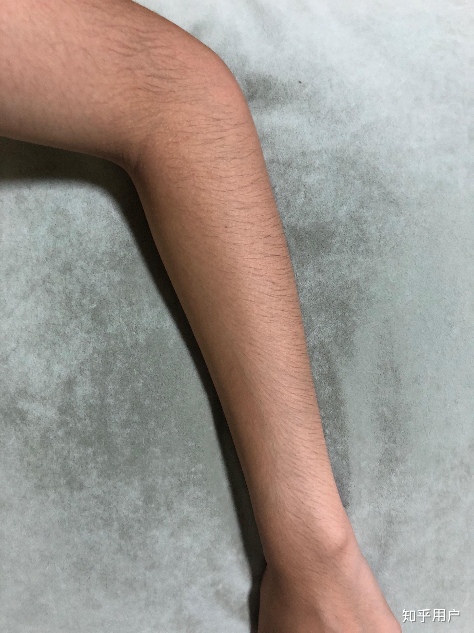 女生汗毛多怎么办