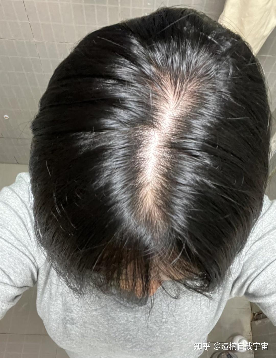 掉发脱发该咋办啊?