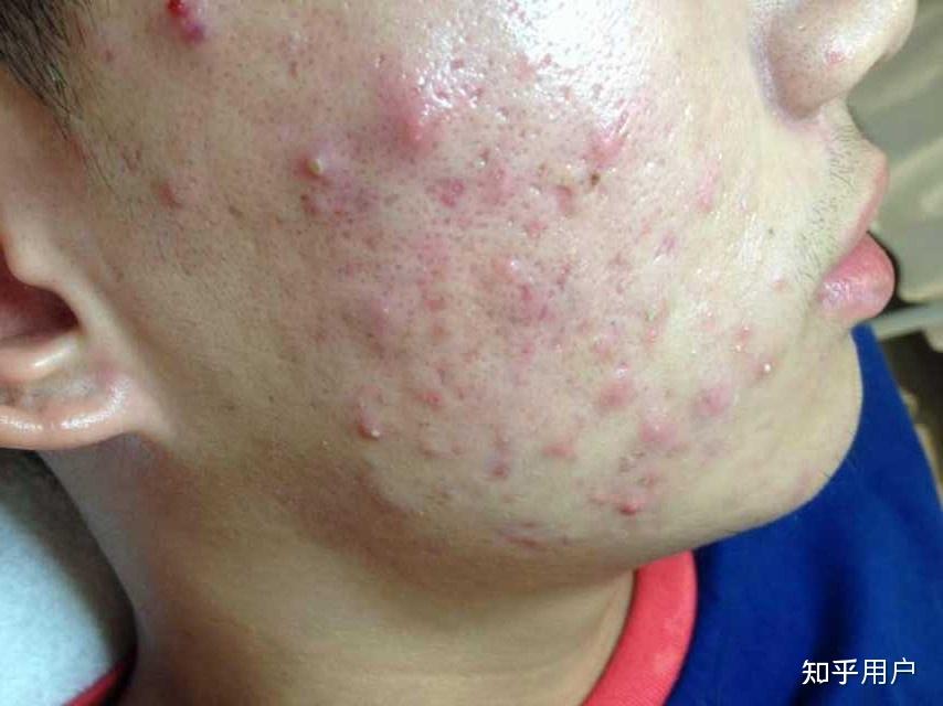 男士如何祛痘