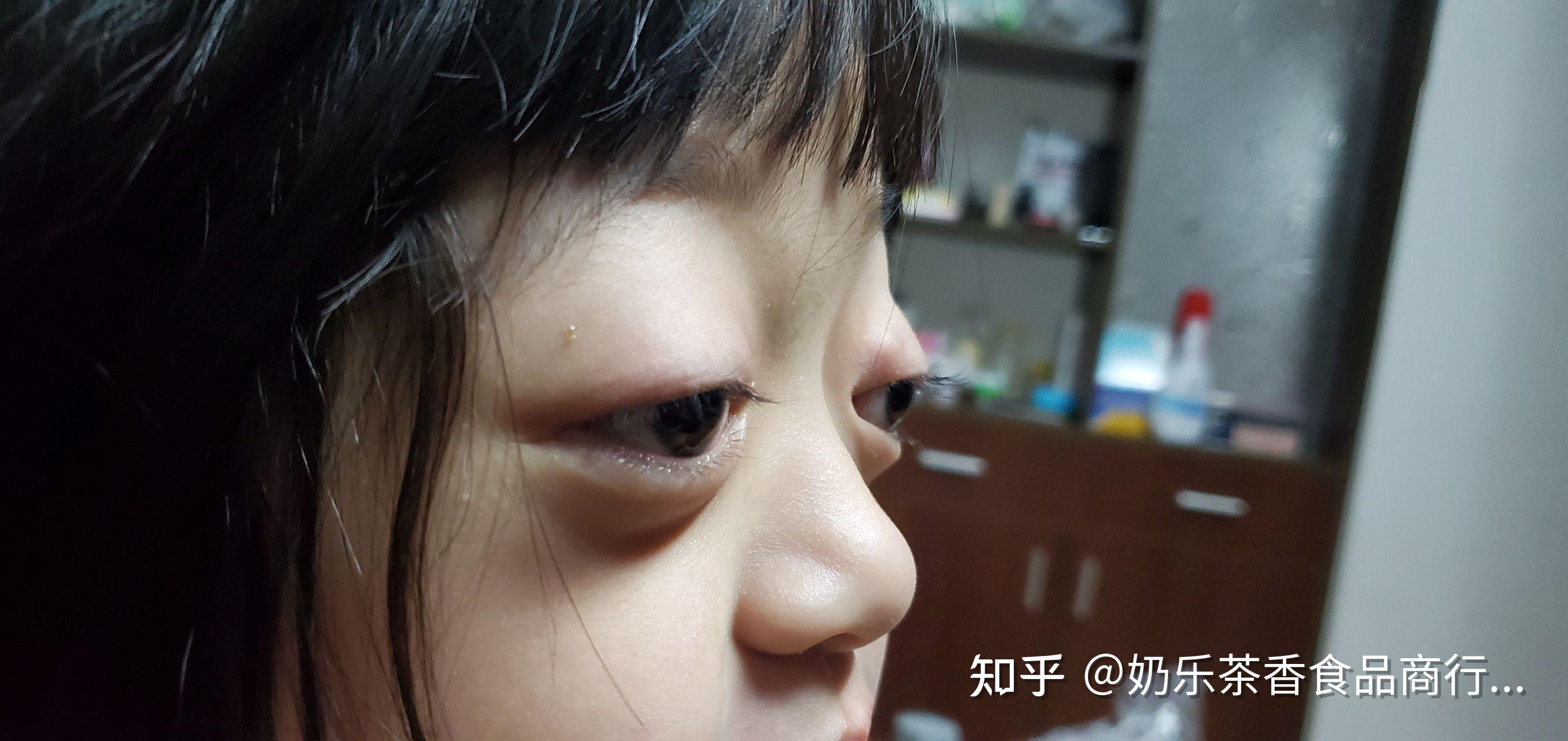 天生性眼球突出遗传是什么原因