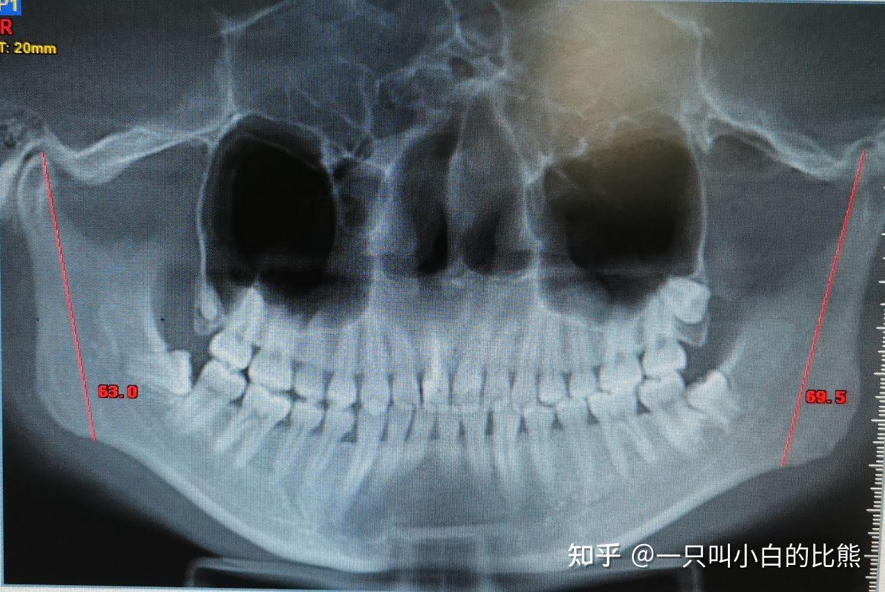 下颌骨ct平扫范围图片图片