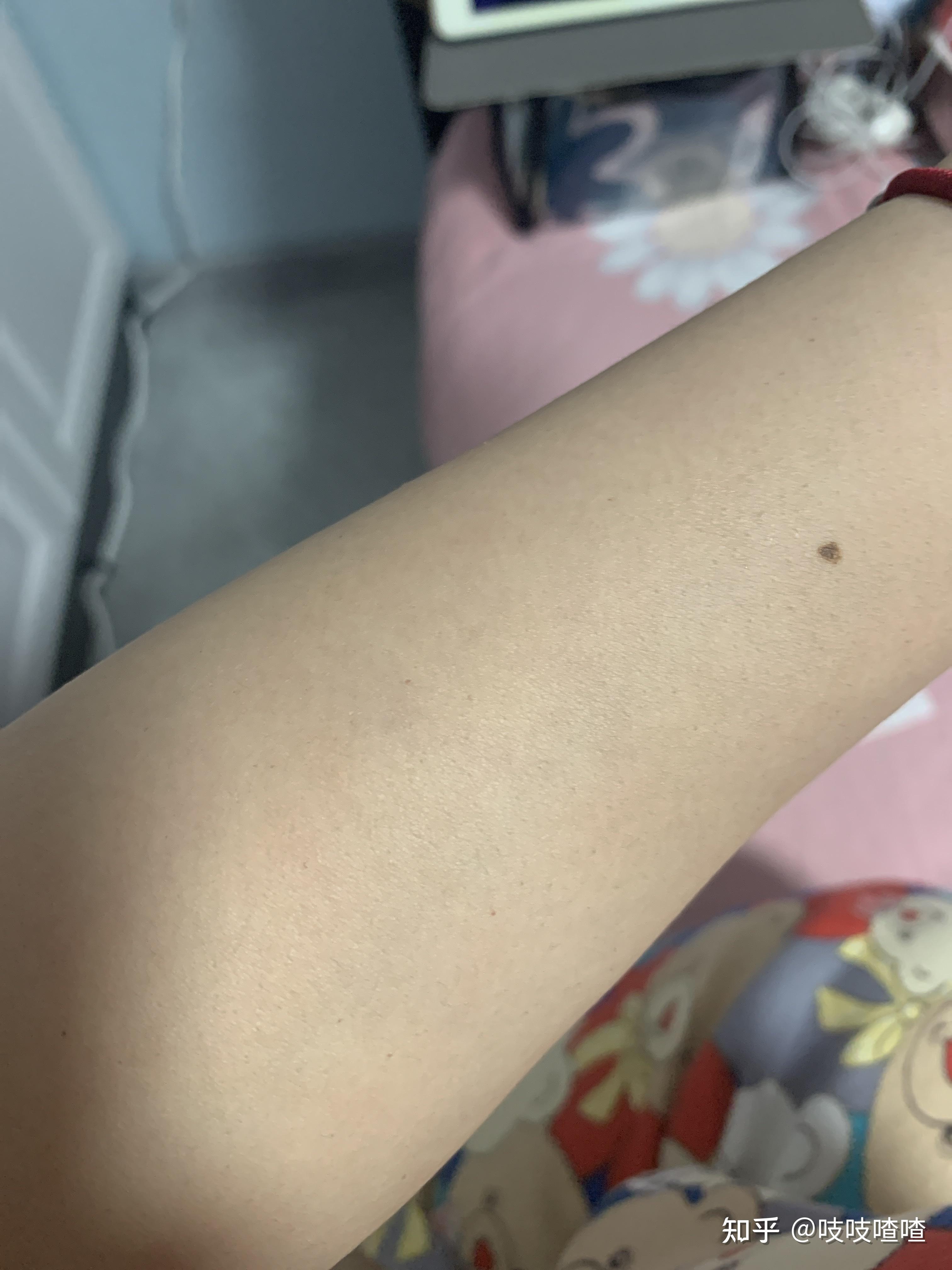 如何改善身体肤色不均匀