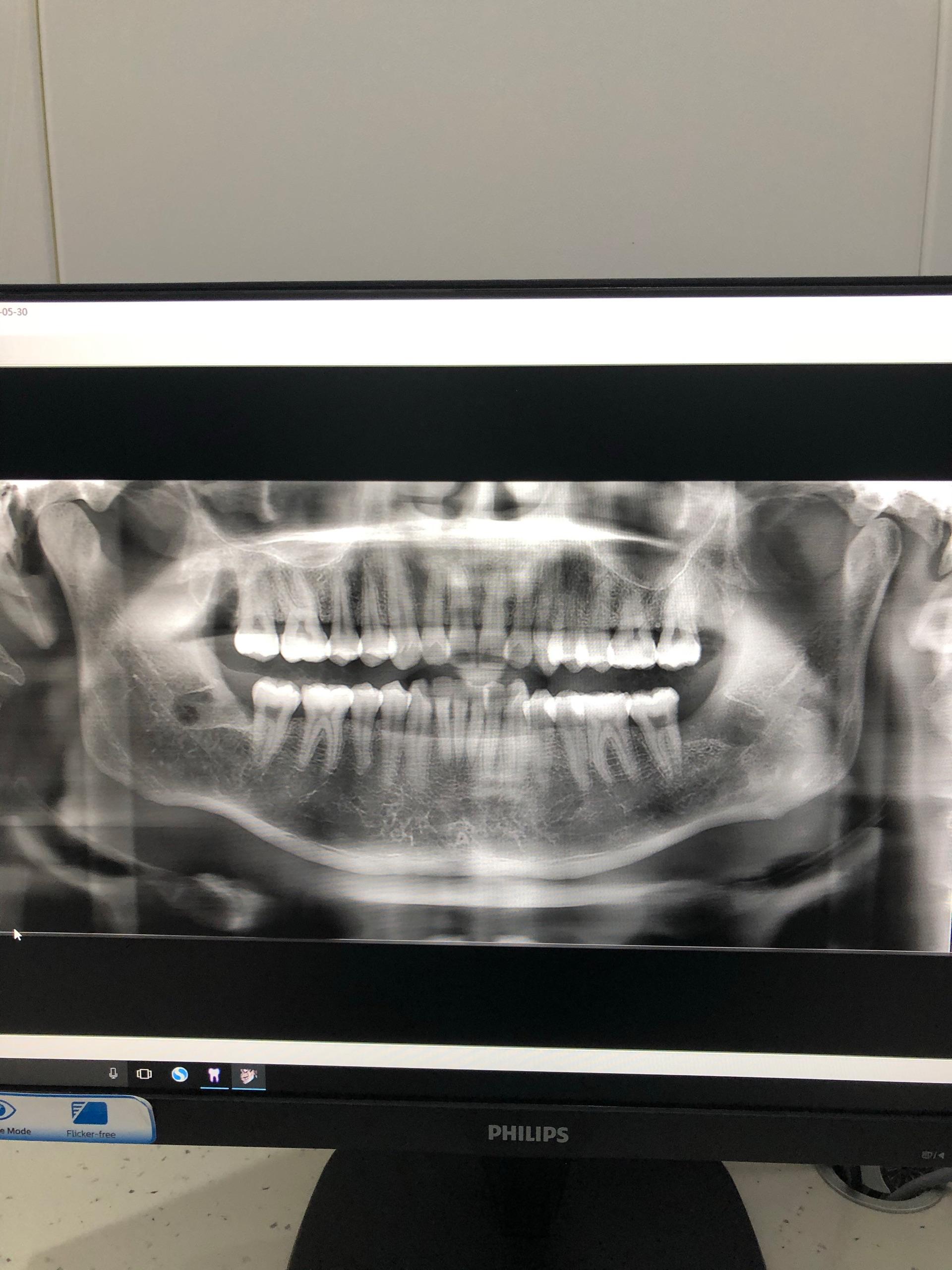 帮忙看下牙片,谢谢? - 知乎