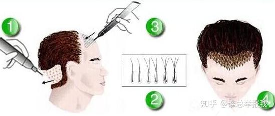 什么时候能治愈秃头 v2-5b81aac0c19b8ce3d1ce871853a9c458_r.jpg