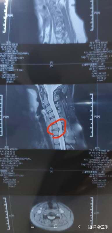 谈谈自己得颈椎病这两个月来的体会 知乎