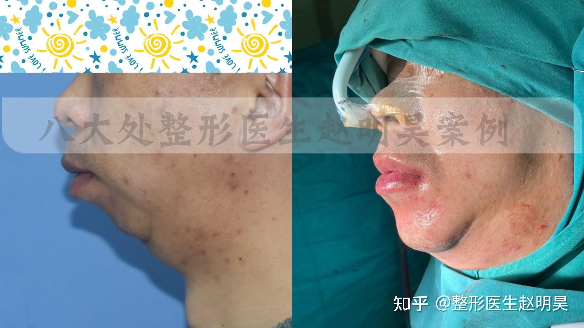 小颌畸形鸟嘴状畸形