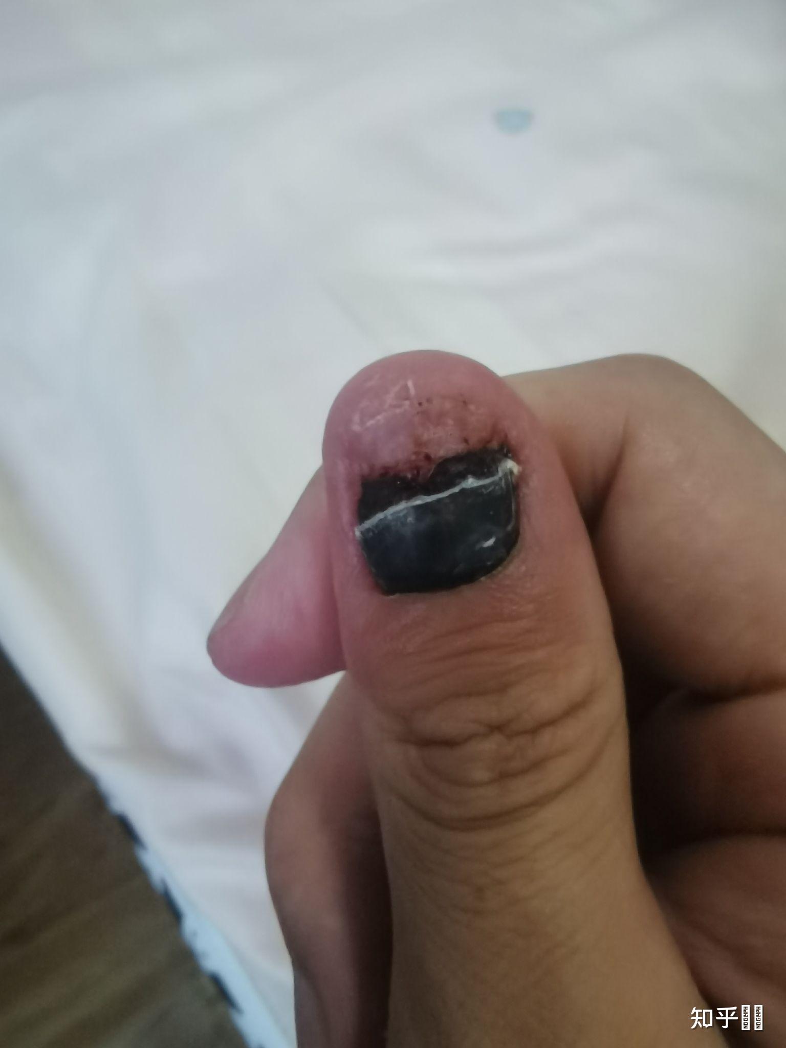 指甲被车门挤伤 指尖全是淤血 怎么办?