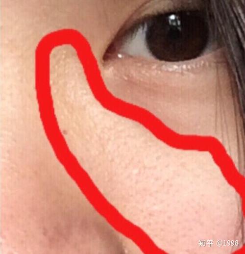 鸡皮肤发红海藻矽针(海藻矽针去鸡皮色素吗)