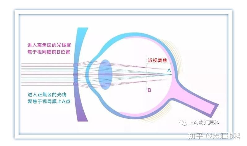 『最新』控制近视新方法——豪雅新乐学镜片 - 知乎