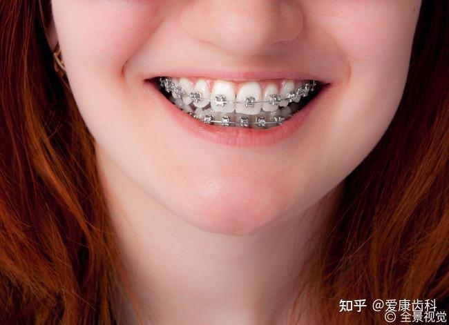 戴牙箍一定要每顿饭后都刷牙吗?在学校怎么办? - 知乎