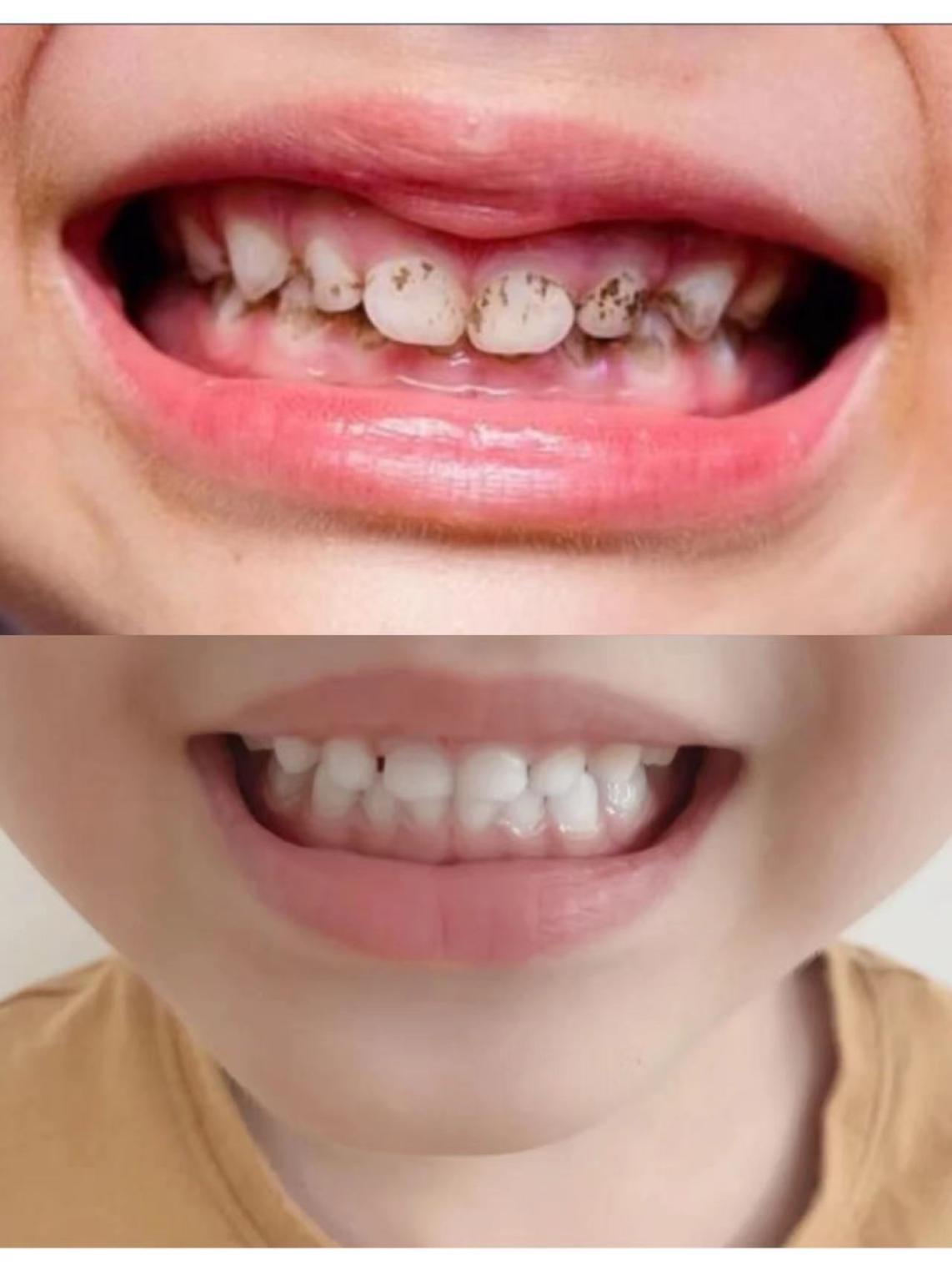 怎么才能让宝宝拥有一口漂亮健康的大白牙