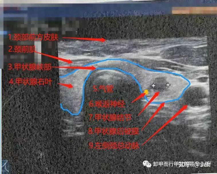 818如何辨識甲狀腺超聲報告中結節方位和周邊組織