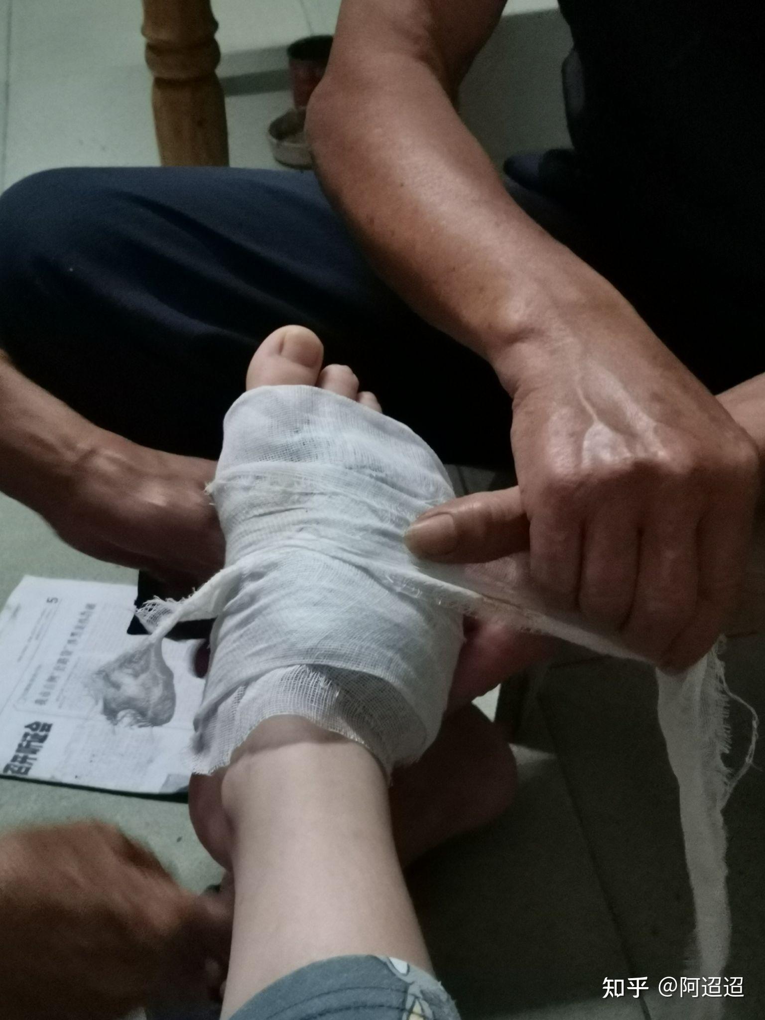 学校,杵着两根拐杖上课,每天洗完澡之后要自己把中草药炒热换药……6