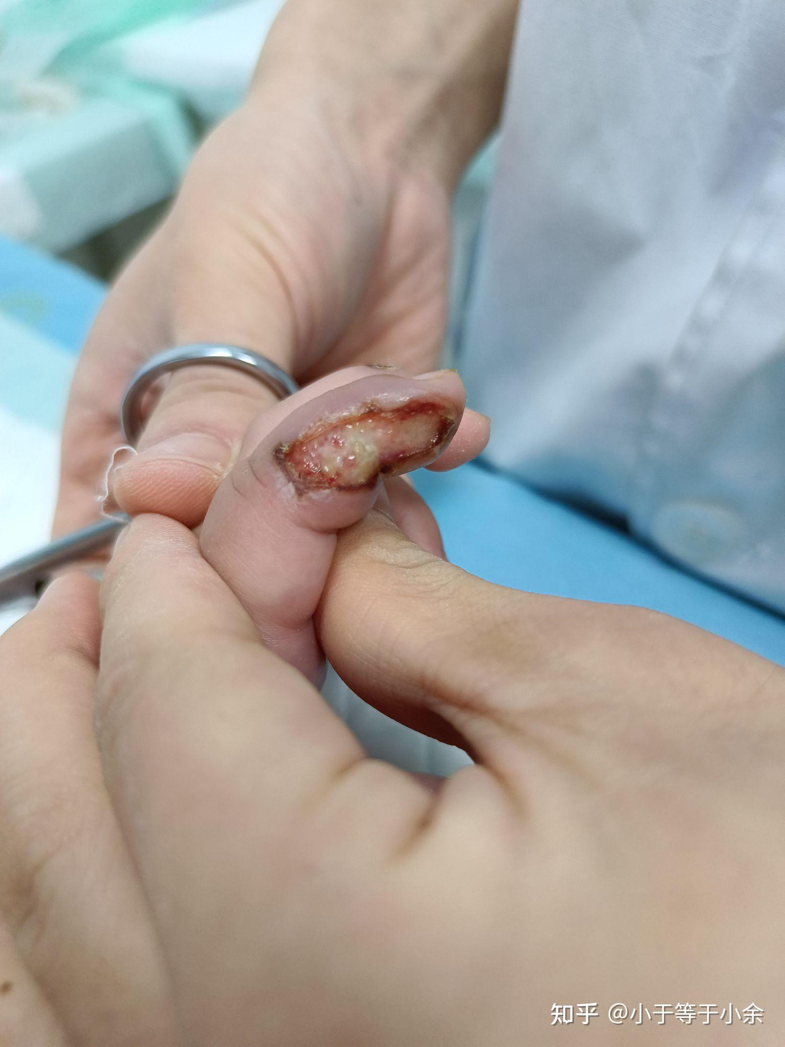 14个月宝宝电击伤的恢复路程