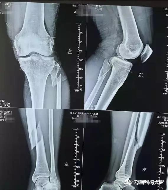 小腿骨折的微创手术 胫骨骨折髓内钉手术图 木辰网