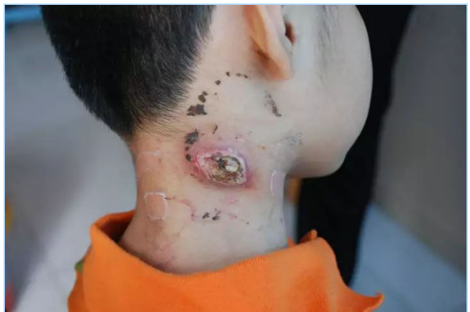 淋巴结核本身真的不具有传染性?为什么会出现