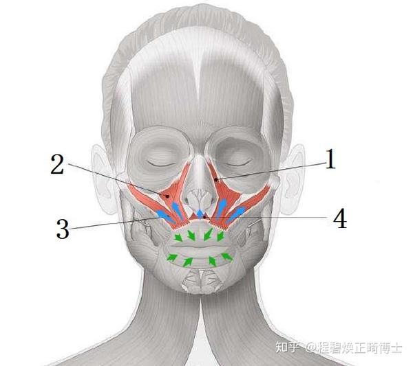 图中1~4 为导致上唇短的肌群(主要是 提上唇肌群) 蓝色箭头代表提上唇