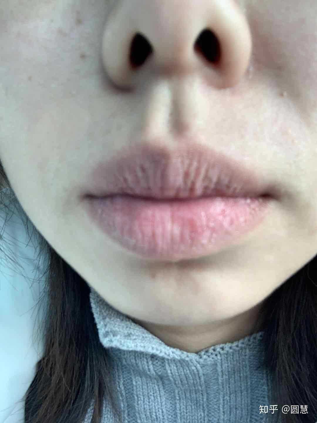 厚嘴唇 做改薄手术是否真的有用？
