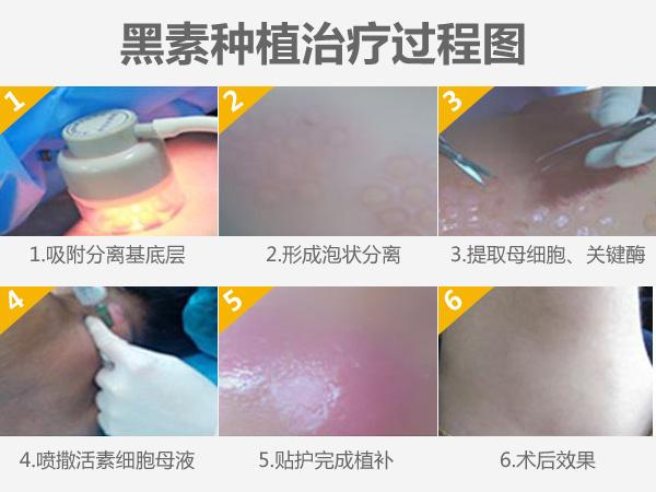 大面积白斑选择黑色素种植技术费钱吗