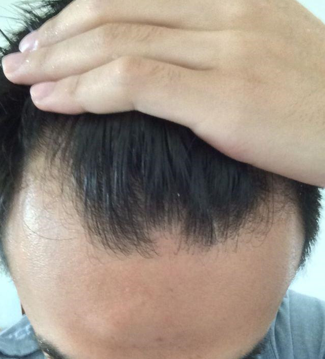 20岁m型脱发长回来了,20岁m型脱发能恢复吗