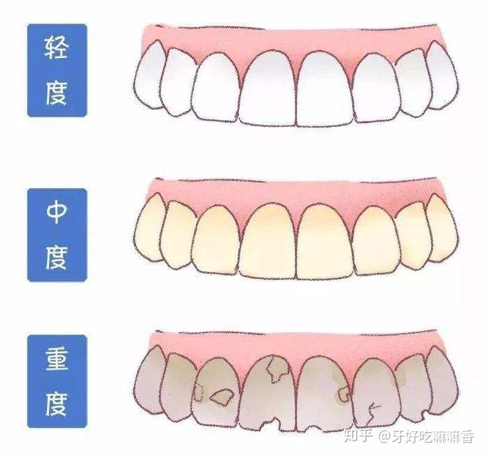 牙齒會隨著年齡的增長而變黃嗎