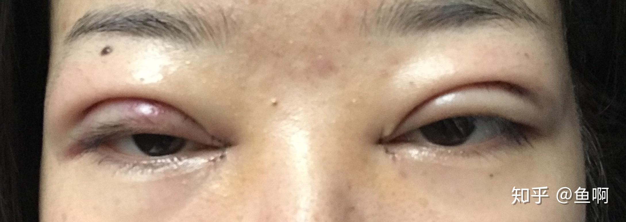 有割完双眼皮上眼睑外翻的现象的吗?能恢复吗? - 知乎