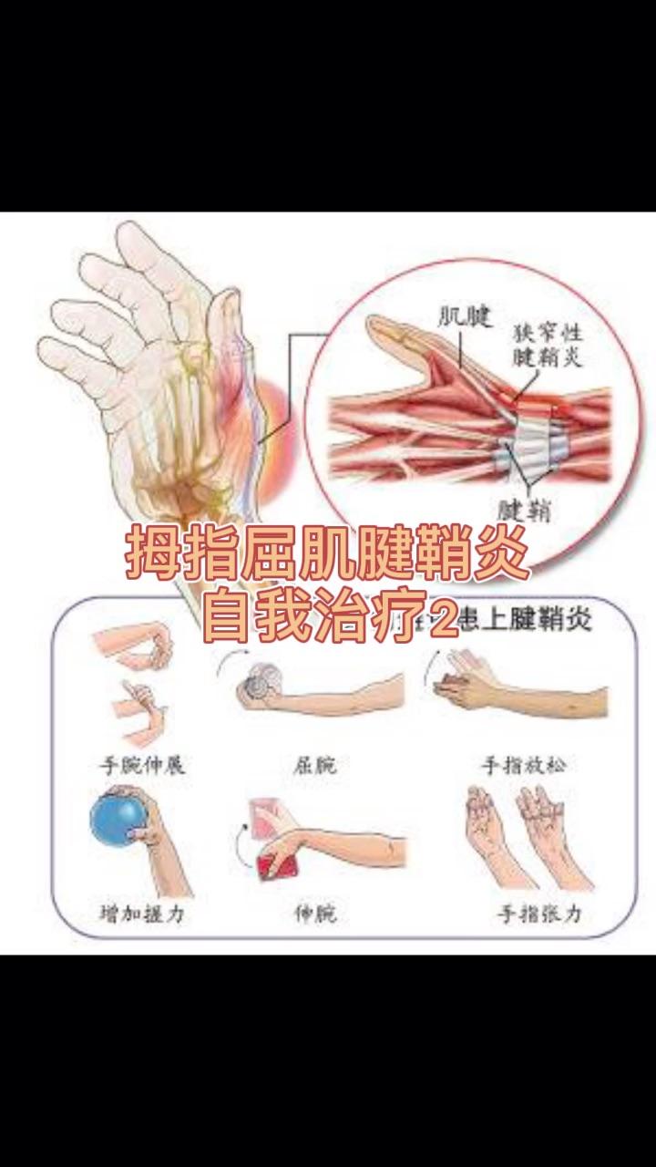 如何判断腱鞘炎图片