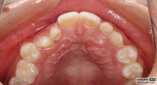 人的上颚有坑坑哇哇的褶皱是起什么作用的?