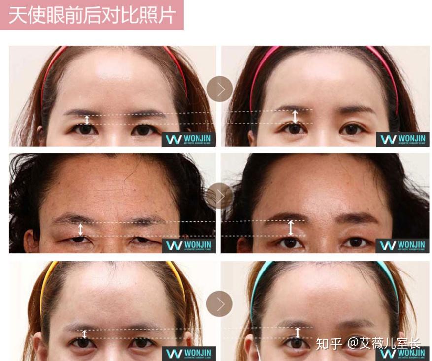 如何有效提拉上眼睑? - 知乎