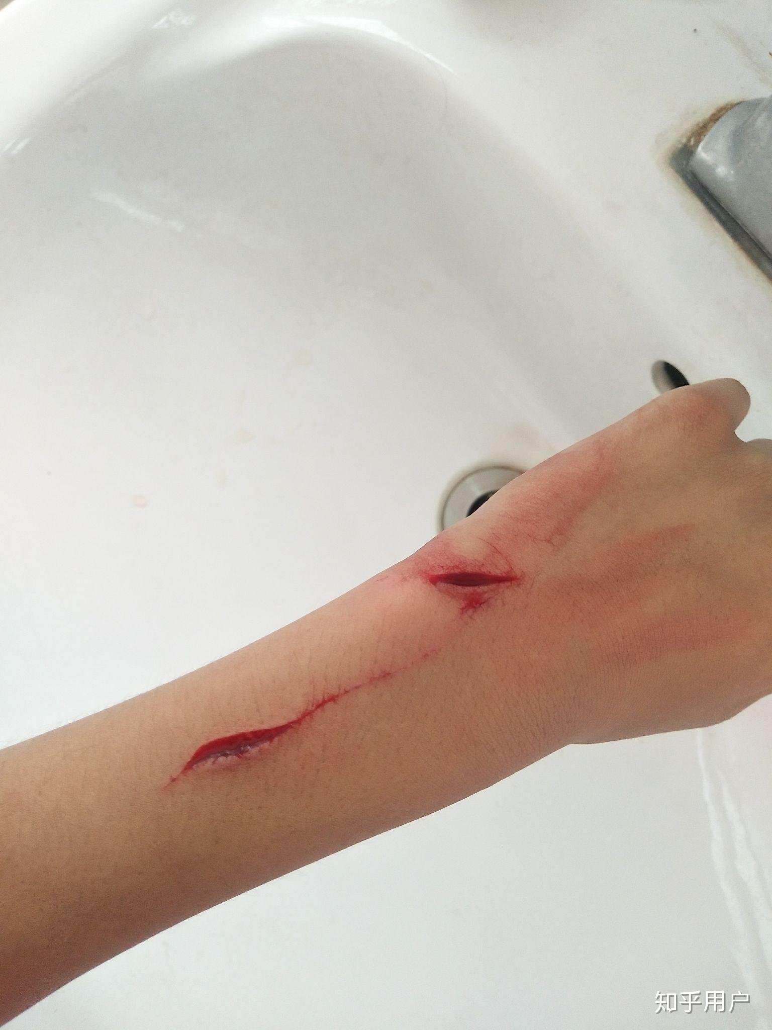 骑自行车摔了一跤现在夏天伤口结痂大概多久可以洗澡呢