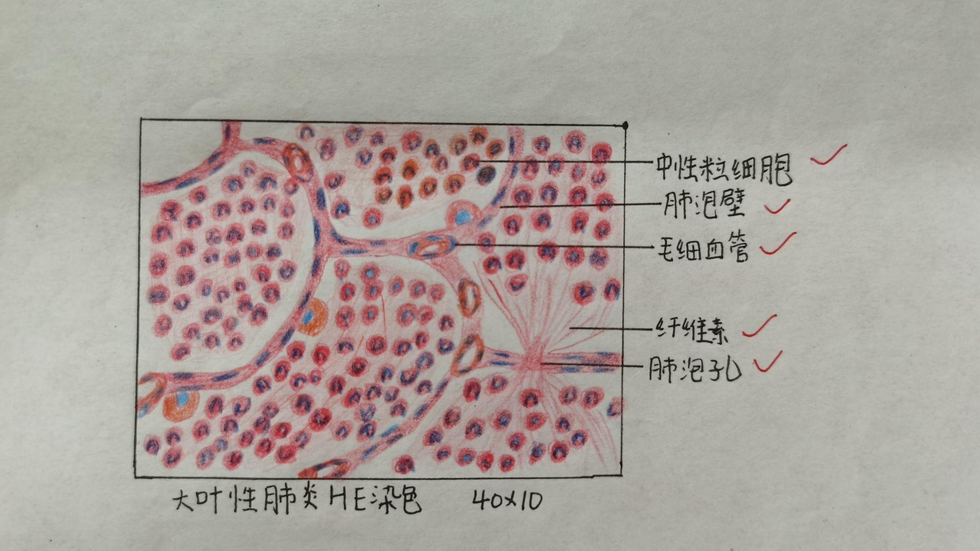 病理切片紅藍鉛筆手繪圖 - 知乎