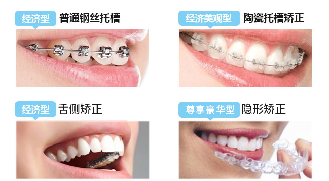 其中金属和陶瓷有传统牙套和自锁牙套的区别,隐形牙套虽然品牌有很多