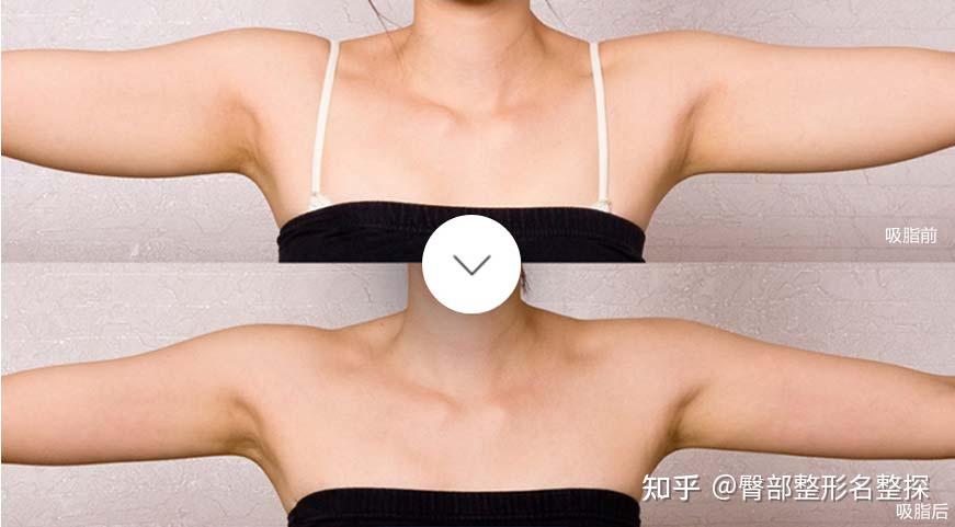 蝴蝶袖是什么?手臂吸脂能解决蝴蝶袖问题吗? - 知乎