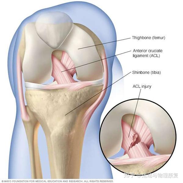 前交叉韧带重建手术后多久可以正常行走和生活 知乎