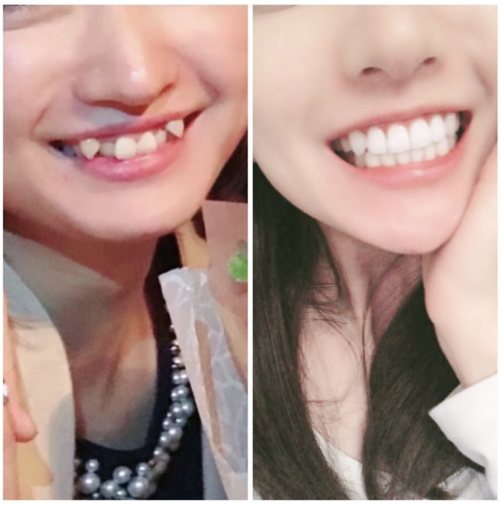 有虎牙要不要做牙齿矫正