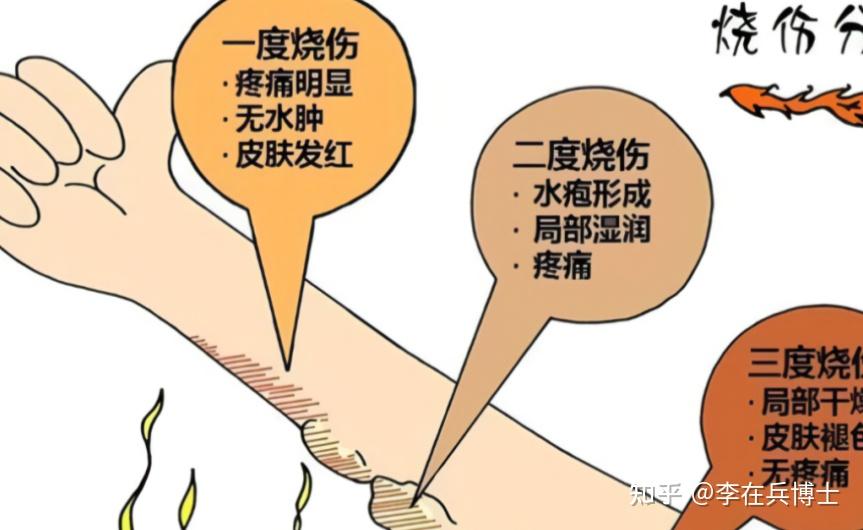 烧伤怎么办?这些干货你要记住 - 知乎