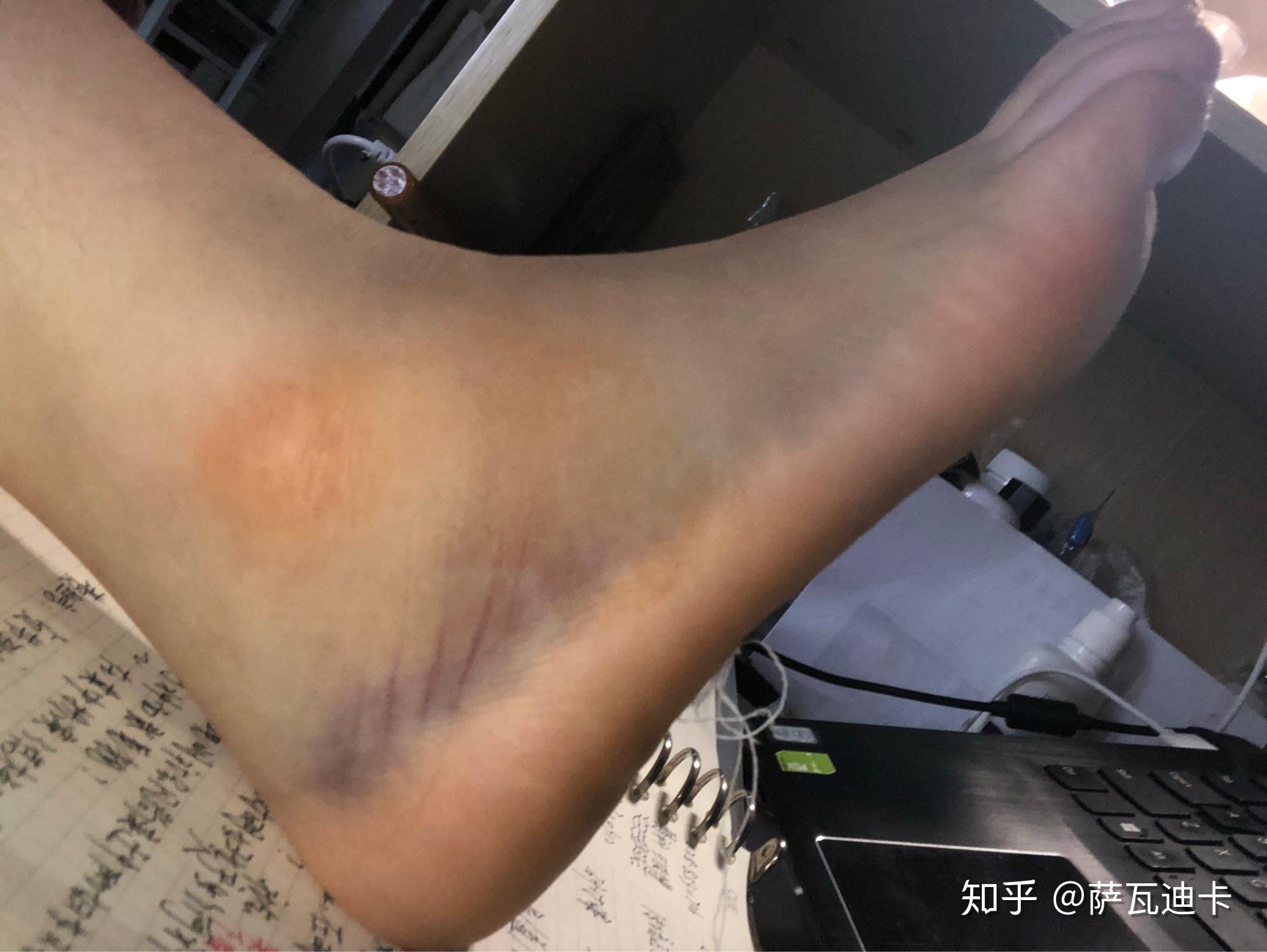 右脚踝轻微骨折大概多久能好平时要怎么坐