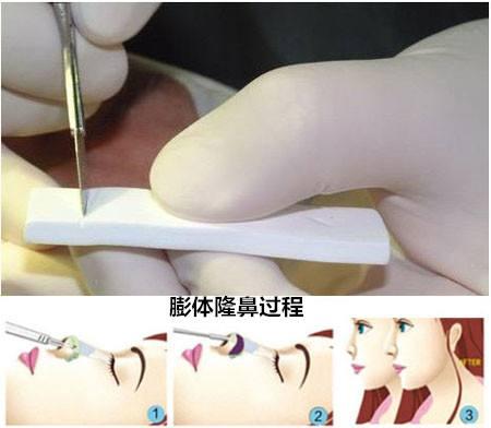 膨体和硅胶假体隆鼻有什么区别