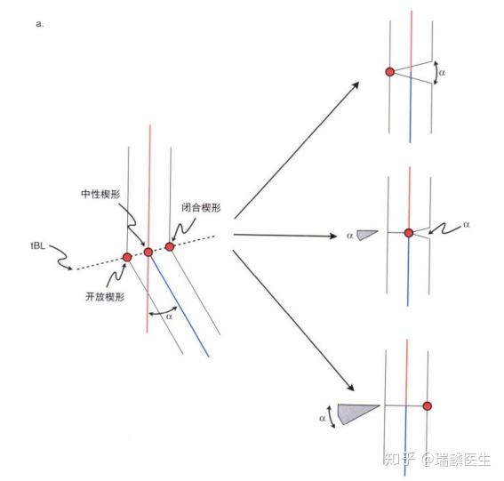 a 单纯矫正成角的截骨术;b 矫正成角合并移位的截骨术