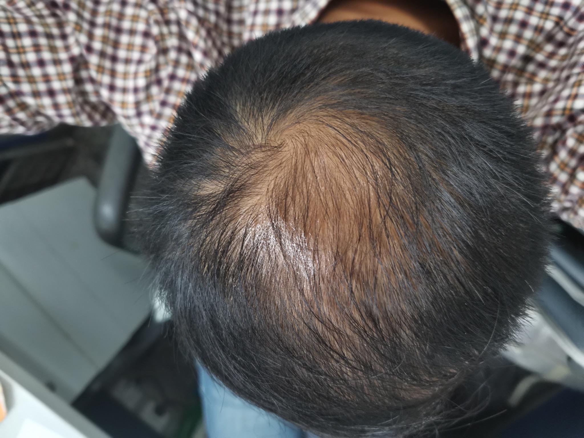 脂溢性脱发还能长回来吗脱发的最佳治疗方案是哪种