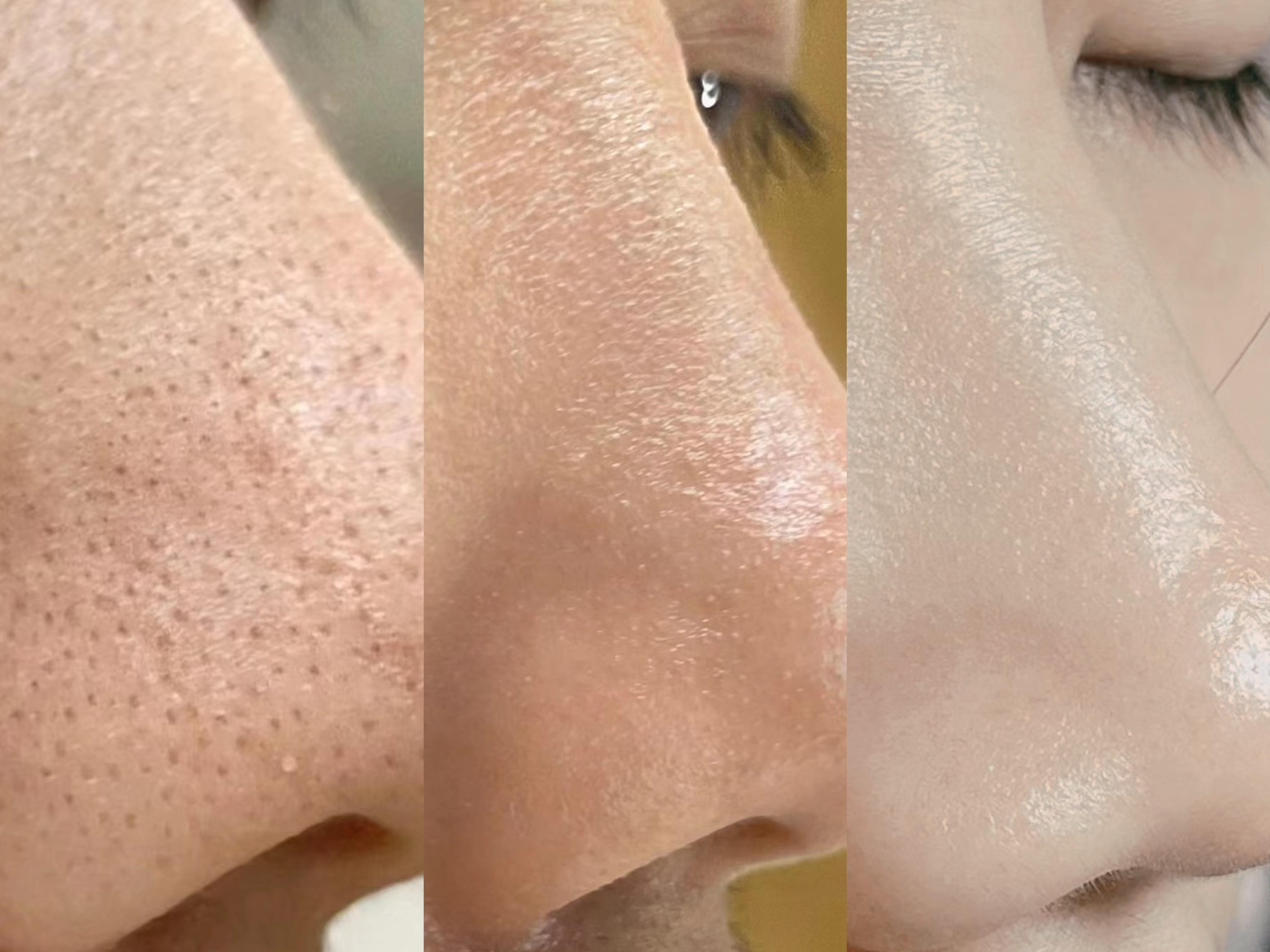 【男生去黑头必看】男生怎么做才能把脸上的黑头“连根拔起”?还不反复!【皮肤科医生】教你4步男生去黑头的方法,将黑头一扫而光!