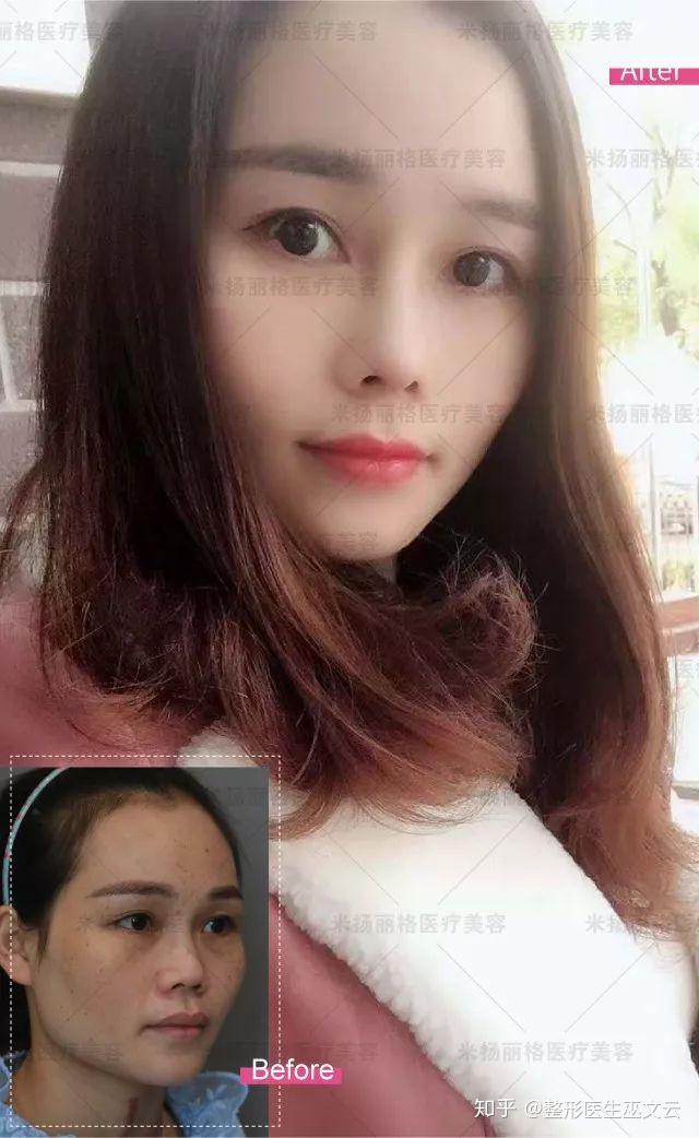 肋软骨膨体鼻综合案例巫文云