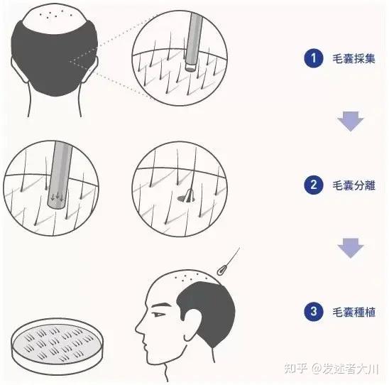 植发手术成功方法(植发手术成功率高吗)
